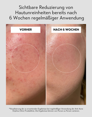 Gesichtstoner gegen Akne mit Niacinamid und Azelainsäure Anti-Acne Orphica Clinic 200 ml - 5