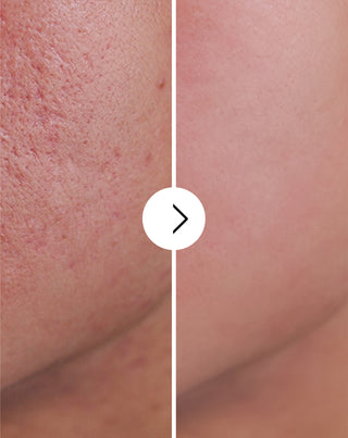 Tabletten gegen Akne, Pickel und Hautunreinheiten mit Zink, Vitamin C, E und B2 Derminax_4 - 4