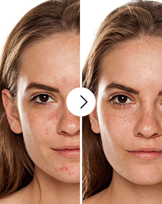 Tabletten gegen Akne, Pickel und Hautunreinheiten mit Zink, Vitamin C, E und B2 Derminax_2 - 2