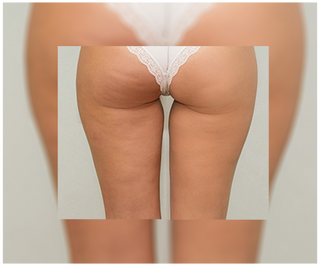 Tabletten gegen Cellulite und für Verbesserung der Kondition der Haut mit natürlichen Extrakten Cellinea 60 Kapseln - 5