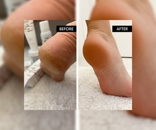 Fußbadesalz mit Urea 45% Refeet