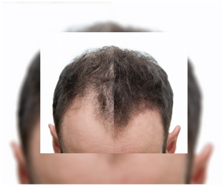 Kapseln gegen Haarausfall mit verdichtender und stärkender Wirkung Follixin 60 Kapseln