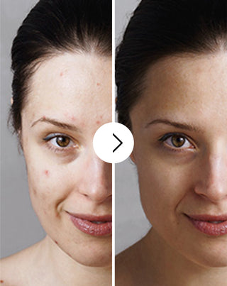 Tabletten gegen Akne, Pickel und Hautunreinheiten mit Zink, Vitamin C, E und B2 Derminax_3