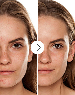 Tabletten gegen Akne, Pickel und Hautunreinheiten mit Zink, Vitamin C, E und B2 Derminax_2