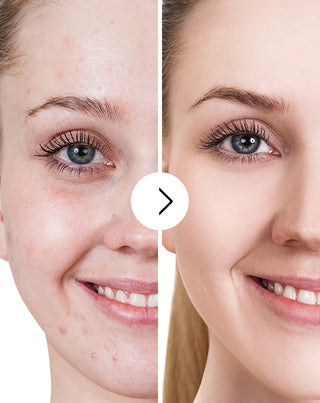 Tabletten gegen Akne, Pickel und Hautunreinheiten mit Zink, Vitamin C, E und B2 Derminax_5